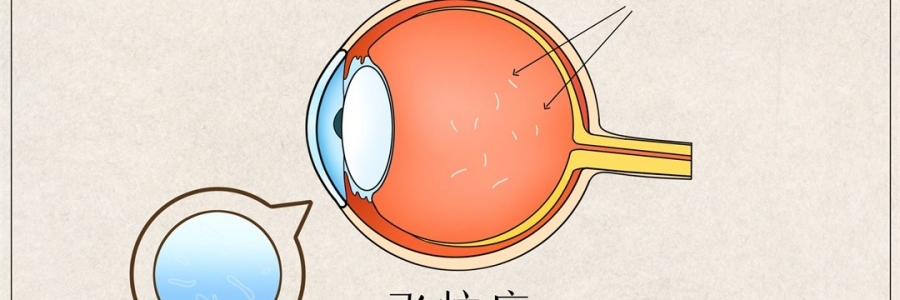 “蚊子”在眼里飛？這類人要注意了！