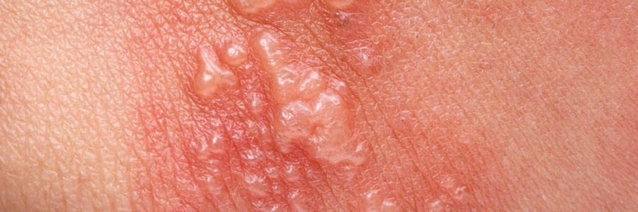 艾灸后起了小水泡，居然是邪氣在“逃跑”！