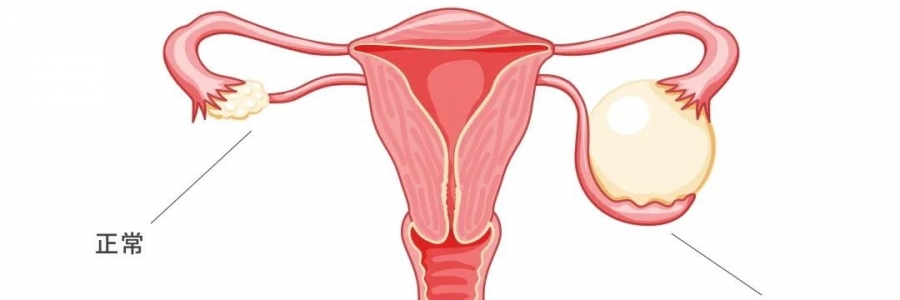 太神奇了，艾灸調好了她的卵巢囊腫！